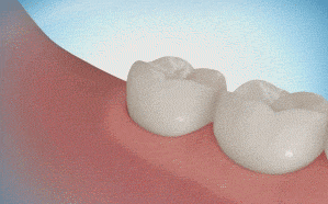 Animation of plaque being brushed away from between two molars at the gumline