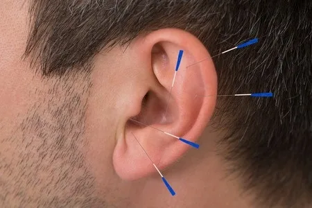 The process of auricular acupuncture