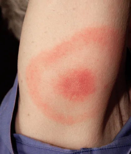 A bullseye (erythema migrans) rash, a classic early sign of Lyme disease